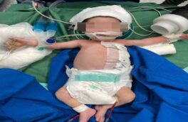 انجام موفقیت‌آمیز عمل جراحی کیست مادرزادی جدار شکم بر روی نوزاد ۱۱ روزه در مرکز آموزشی و درمانی ۱۷ شهریور